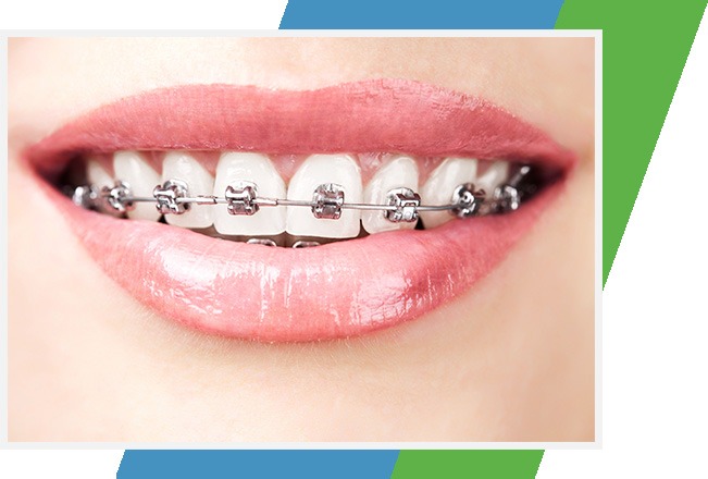 Metal Braces, Sana Dental, Edmonton Dentist