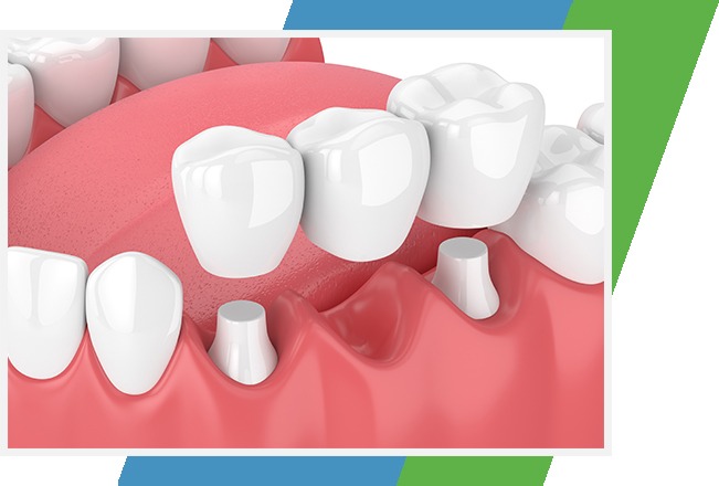 Dental Bridges | Sana Dental | General & Family Dentist | North Edmonton