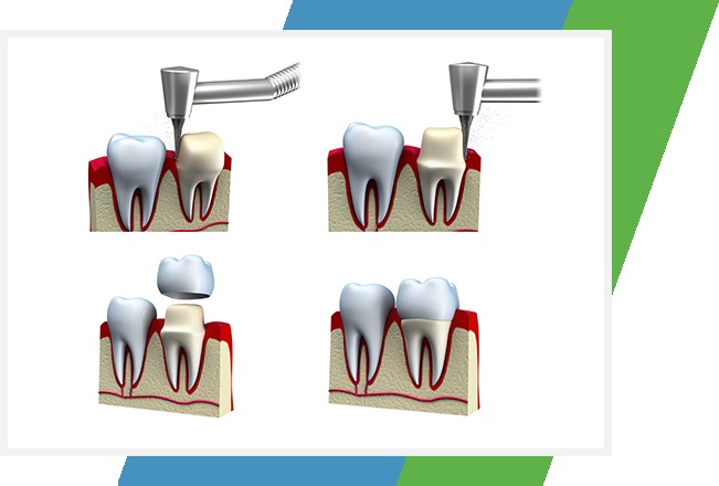 Dental Crowns | Sana Dental | General & Family Dentist | North Edmonton