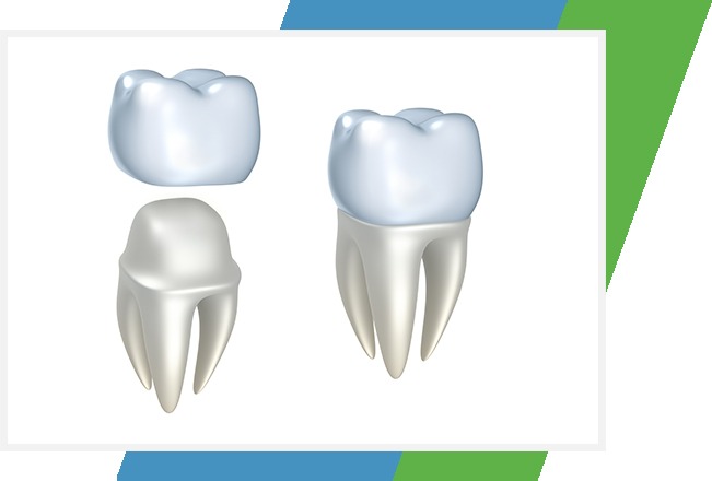 Dental Crowns | Sana Dental | General & Family Dentist | North Edmonton