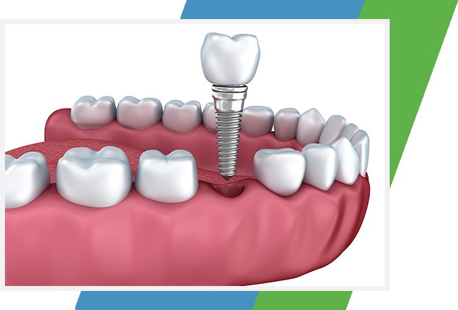 Dental Implants | Sana Dental | General & Family Dentist | North Edmonton