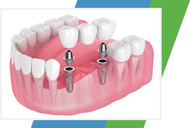 Dental Implants | Sana Dental | General & Family Dentist | North Edmonton