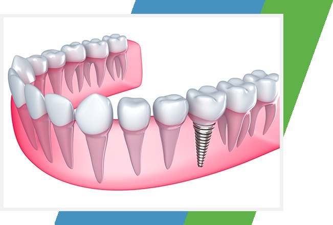 Dental Implants | Sana Dental | General & Family Dentist | North Edmonton