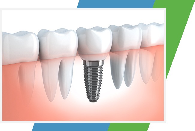 Dental Implants | Sana Dental | General & Family Dentist | North Edmonton