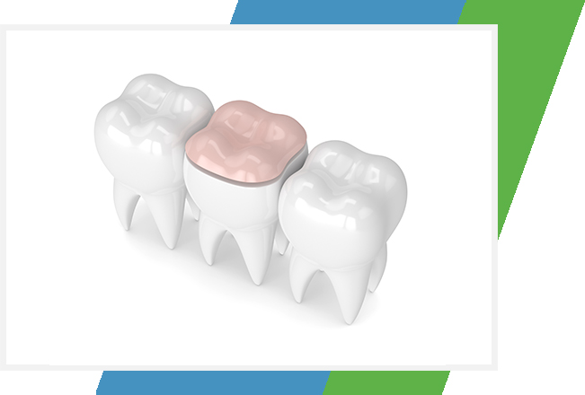 Dental Inlays & Onlays | Sana Dental | General & Family Dentist | North Edmonton