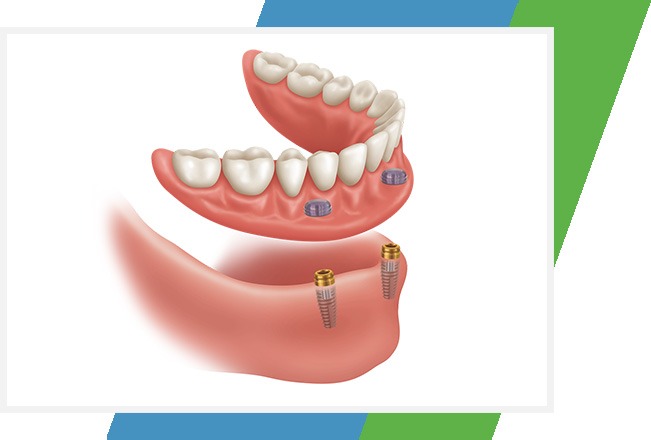 Implant Retained Dentures | Sana Dental | General & Family Dentist | North Edmonton