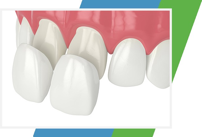 Porcelain Veneers | Sana Dental | General & Family Dentist | North Edmonton