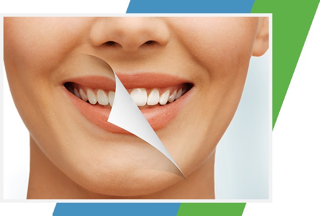 Teeth Whitening | Sana Dental | General & Family Dentist | North Edmonton