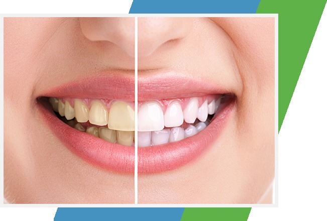 Teeth Whitening | Sana Dental | General & Family Dentist | North Edmonton
