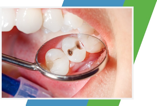 Tooth Coloured Fillings | Sana Dental | General & Family Dentist | North Edmonton
