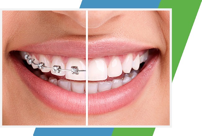 Metal Braces, Sana Dental, Edmonton Dentist