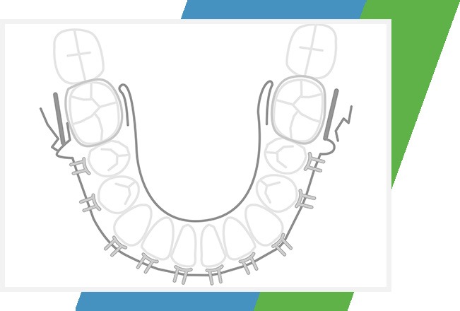 ARA Controlled Arch Sleep Device | Sana Dental | General & Family Dentist | North Edmonton